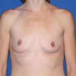 Breast Augmentation