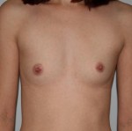 Breast Augmentation