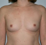 Breast Augmentation