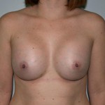 Breast Augmentation