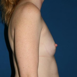 Breast Augmentation