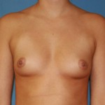 Breast Augmentation
