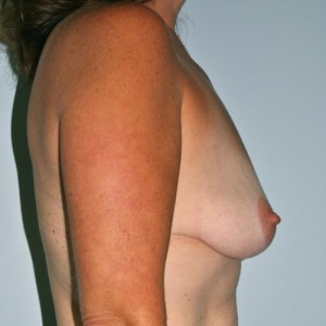 Breast Augmentation