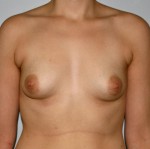Breast Augmentation