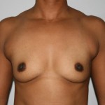 Breast Augmentation