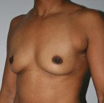 Breast Augmentation