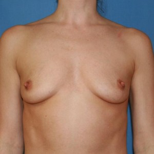 Breast Augmentation