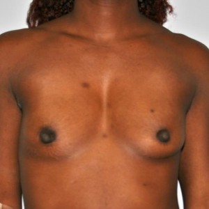 Breast Augmentation