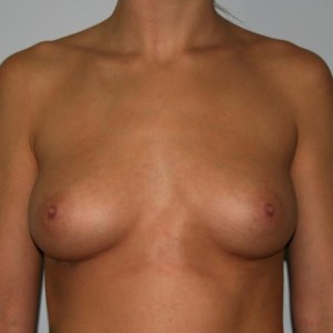 Breast Augmentation