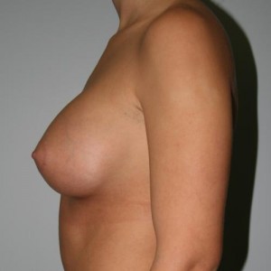 Breast Augmentation