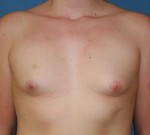 Breast Augmentation