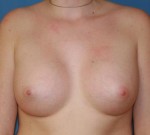 Breast Augmentation