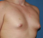 Breast Augmentation
