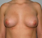 Breast Augmentation