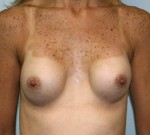 Breast Augmentation