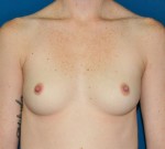 Breast Augmentation