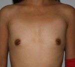 Breast Augmentation