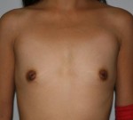 Breast Augmentation