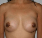 Breast Augmentation