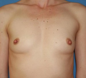 Breast Augmentation