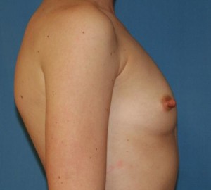 Breast Augmentation