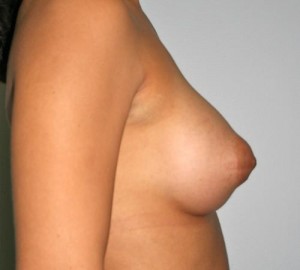 Breast Augmentation