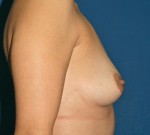 Natural Breast Augmentation