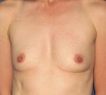 Natural Breast Augmentation