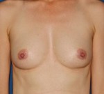 Natural Breast Augmentation