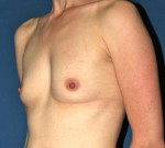 Natural Breast Augmentation