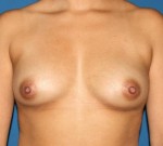 Natural Breast Augmentation