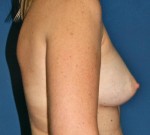 Natural Breast Augmentation