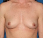 Natural Breast Augmentation