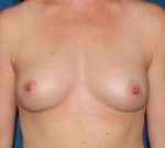 Natural Breast Augmentation