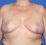 Breast Reduction
