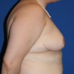 Breast Reduction