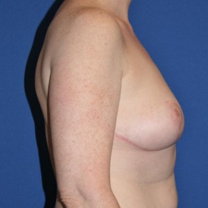 Breast Reduction