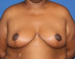 Breast Reduction