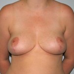 Breast Reduction