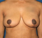 Breast Reduction