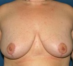 Breast Reduction