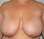 Breast Reduction
