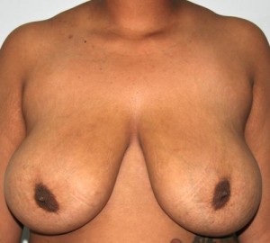 Breast Reduction