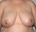 Breast Reduction