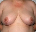 Breast Reduction