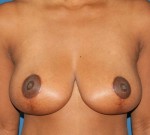 Breast Lift