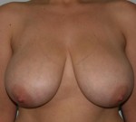 Breast Lift