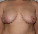 Breast Lift