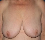 Breast Lift