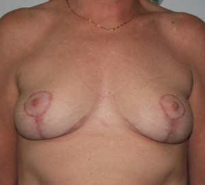 Breast Lift